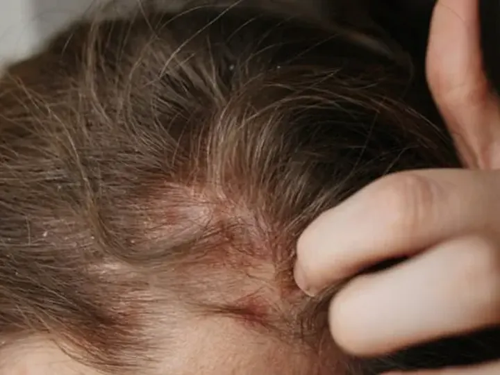 Close up of a scalp with flaking skin near the hairline