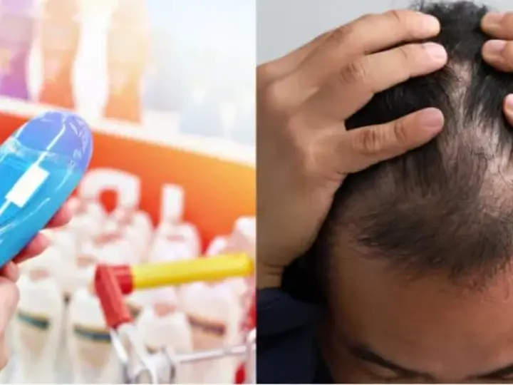 Choosing a shampoo, beside a thinning crown seen from above