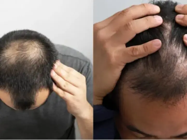 Two men looking at thinning hair on the crown of the head