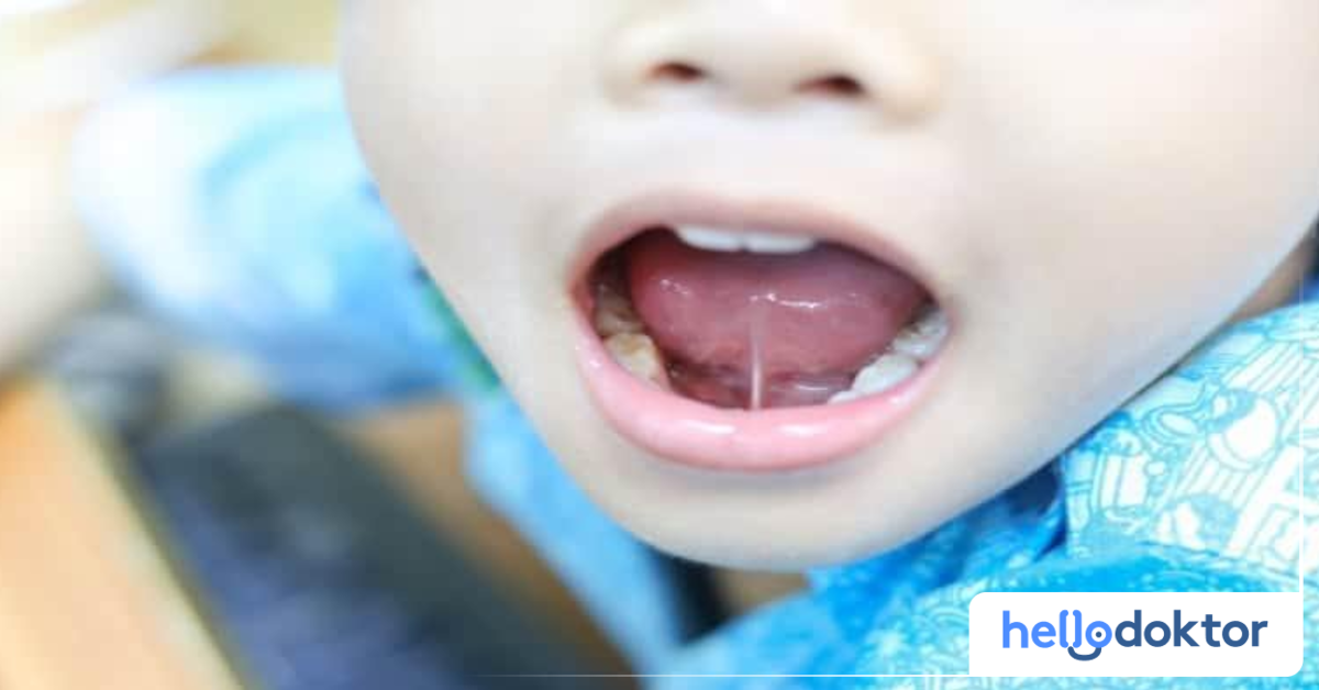 Lidah Bayi Normal Vs Tongue Tie? Ibu Ayah, Ikut Cara Ini Cek Lidah Anak!