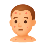 Cacar